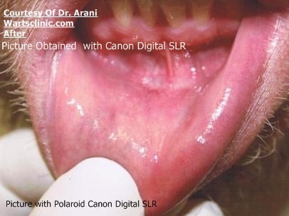 oral wart