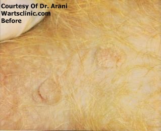 penile warts