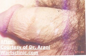 genital warts arani