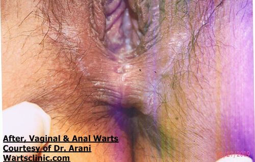 vaginal wart
