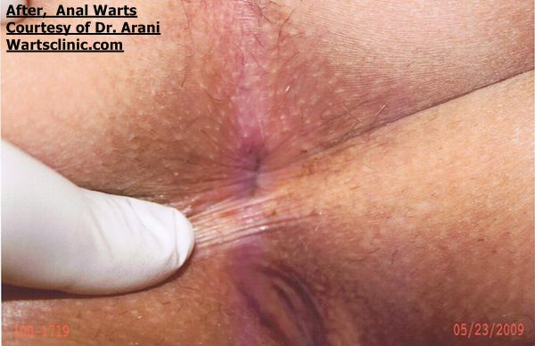 vaginal warts