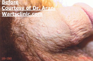 genital warts