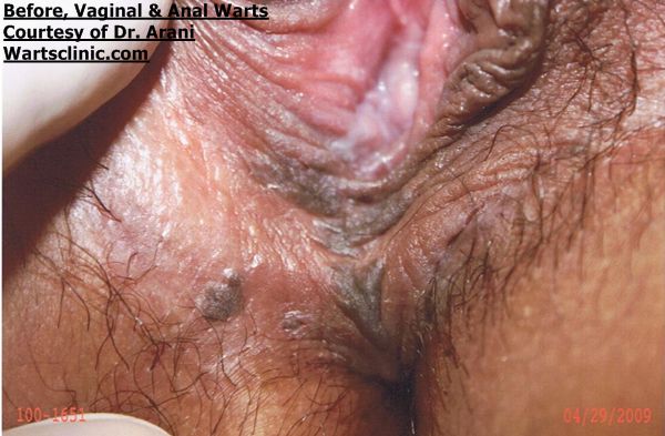 vaginal warts